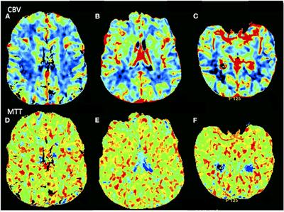 Encephalopathy in COVID-19 Presenting With Acute Aphasia Mimicking Stroke